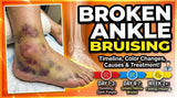 Broken Ankle Bruising: Causes, Color Changes, Timeline, and Treatment
