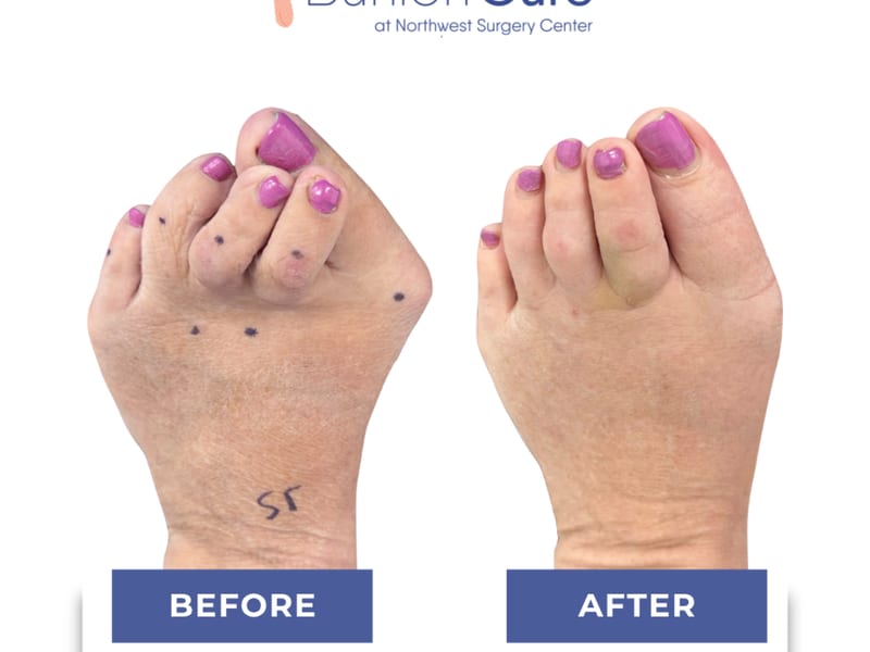 How to Fix Overlapping Toes - Carevion