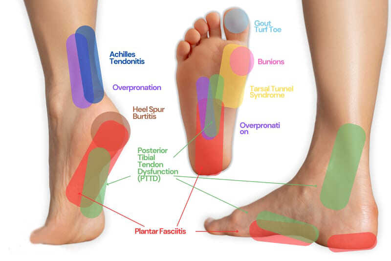 Sore Foot Arch from Running: Causes, Treatment, and What Runners Should Do - Carevion