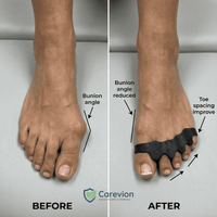 Carevion™ Foot Alignment System Kit - Carevion